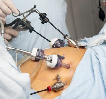 Gastric Sleeve for Weight Loss