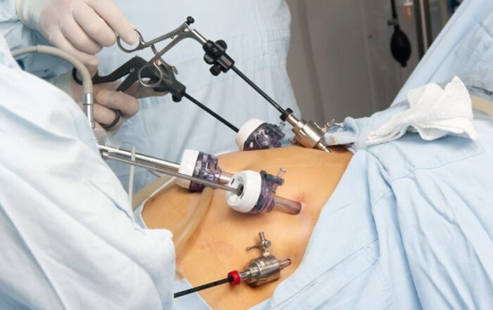 Gastric Sleeve for Weight Loss