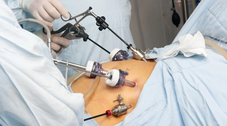 Gastric Sleeve for Weight Loss